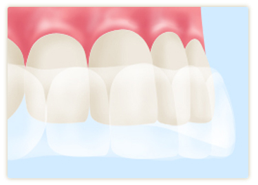 歯を削らずに白くする～ホワイトニング～