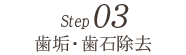 STEP3 歯垢・歯石除去