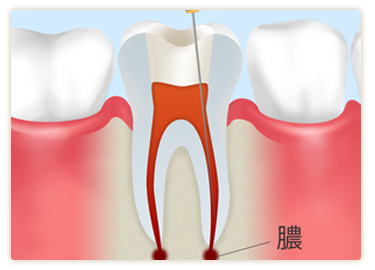 神経にまで達した重度の虫歯の治療～根管治療～