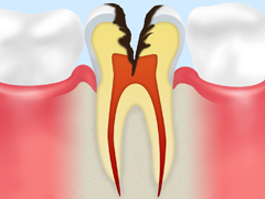 C3：神経に達した虫歯