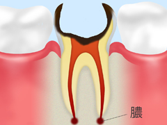 C4：歯根にまで達した虫歯