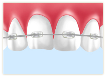 キレイに整った歯並びに～矯正歯科～