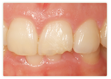 ラミネートべニア