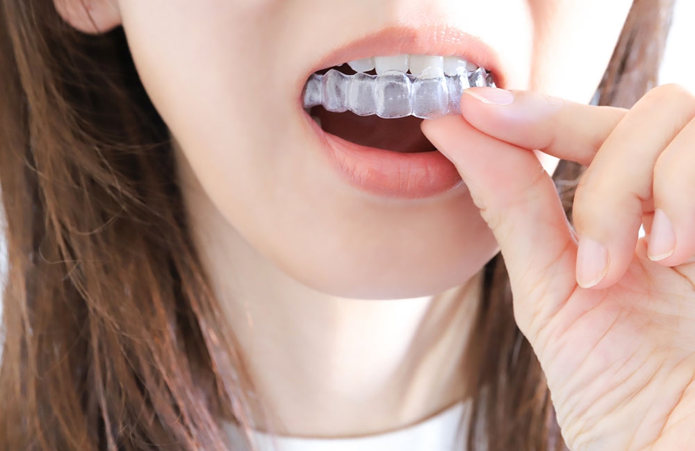 マウスピース矯正