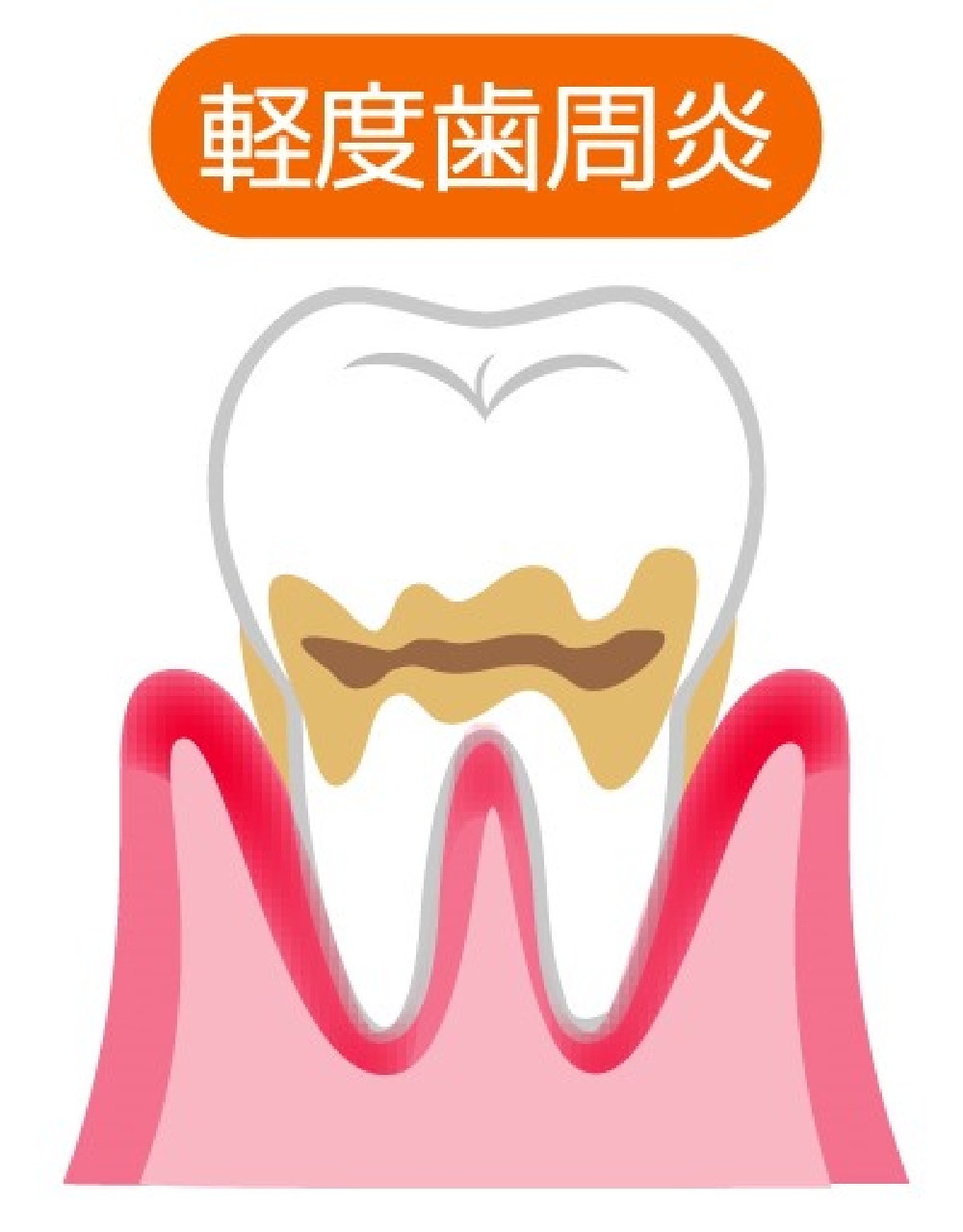 軽度（歯肉炎）