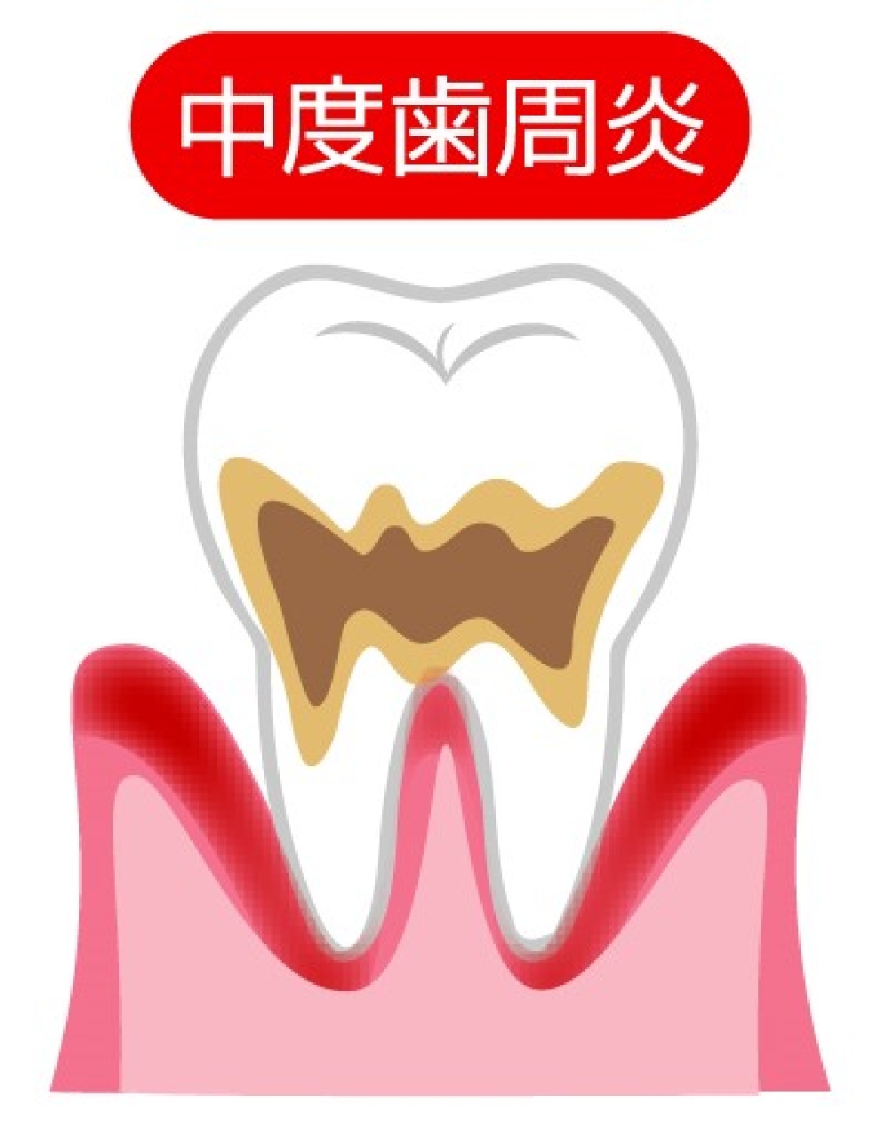 中等度（歯周炎）