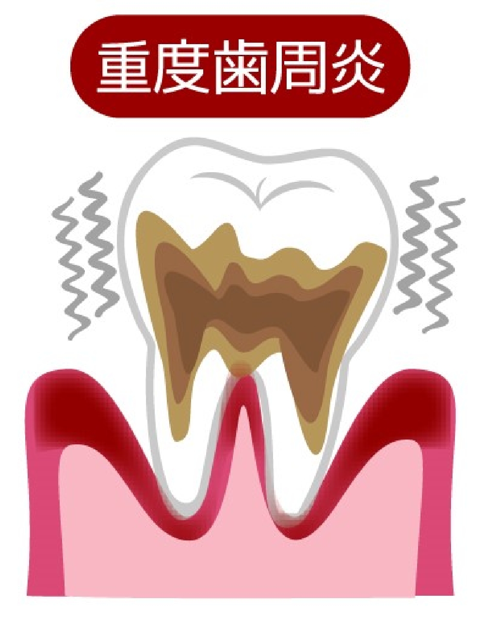 重度（歯周炎）