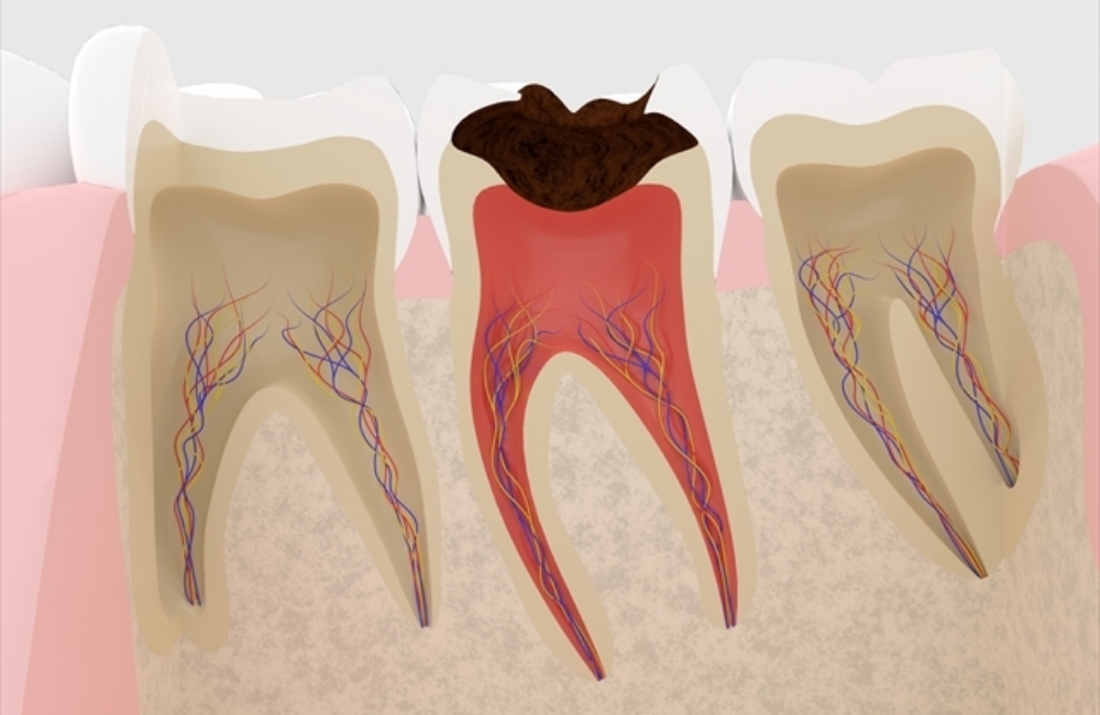 根管治療とは？