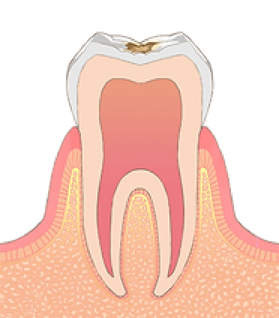 C1：エナメル質の虫歯
