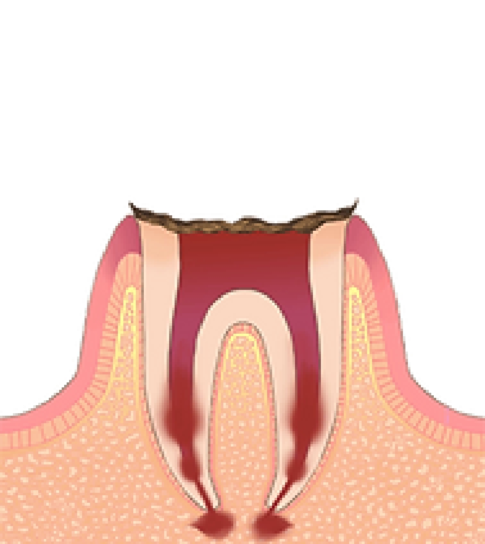 C4：歯根に達した虫歯